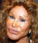Todas contra o botox 